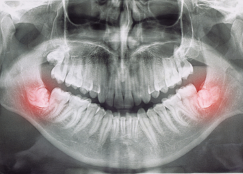 Wisdom Tooth Extraction in Binghamton, NY